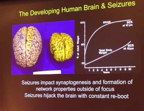 Slide from Dr. Mathern's lecture of pediatric epilepsy surgery 