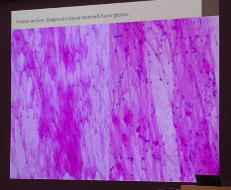 Slide from Dr. Scherpelz’ lecture on glioma diagnosis 