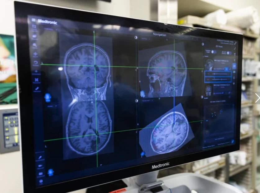 Mukilteo man’s rare brain surgery may help his seizures — and science ...