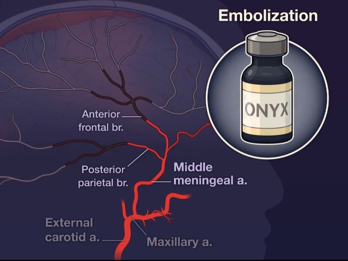 Embolization diagram