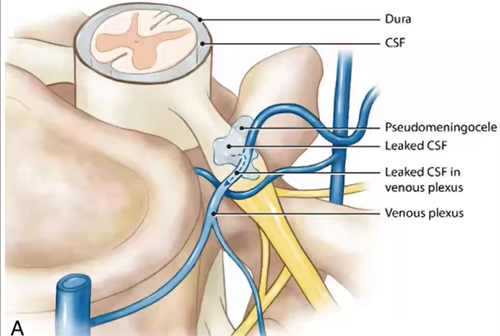 Diagram of cerebrospinal fluids