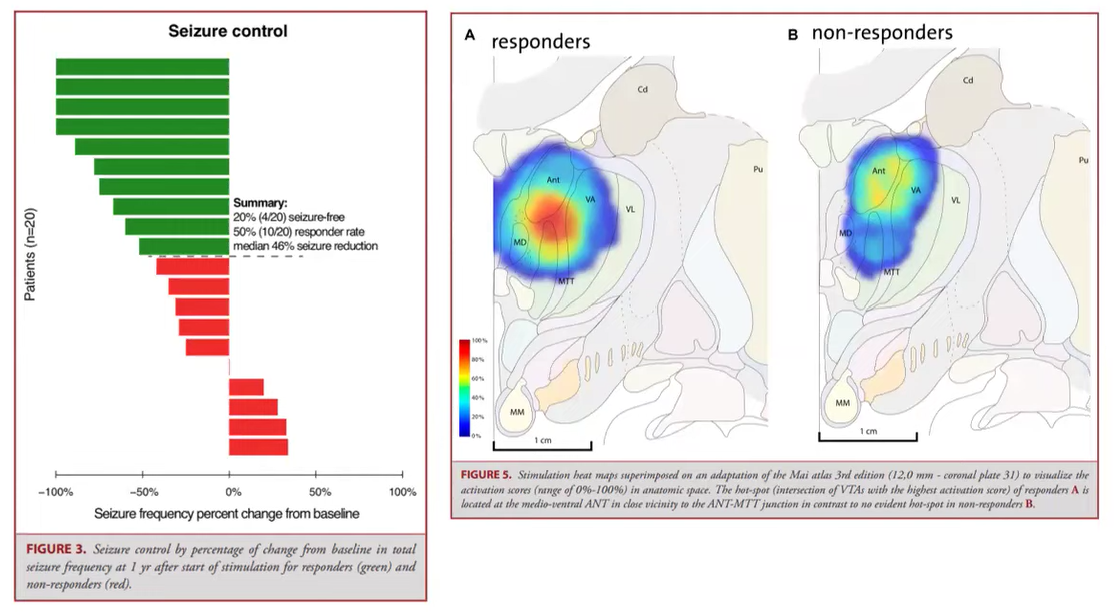 Graphs and imagery describing seizure mapping