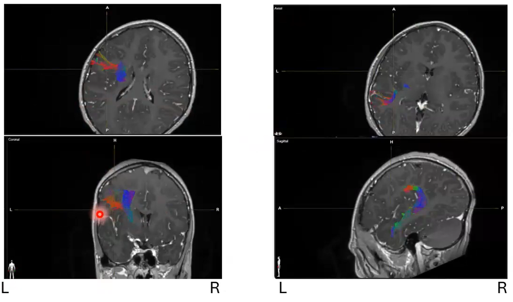 Photos of different CT scans of the brain with a hot spot highlighted in red