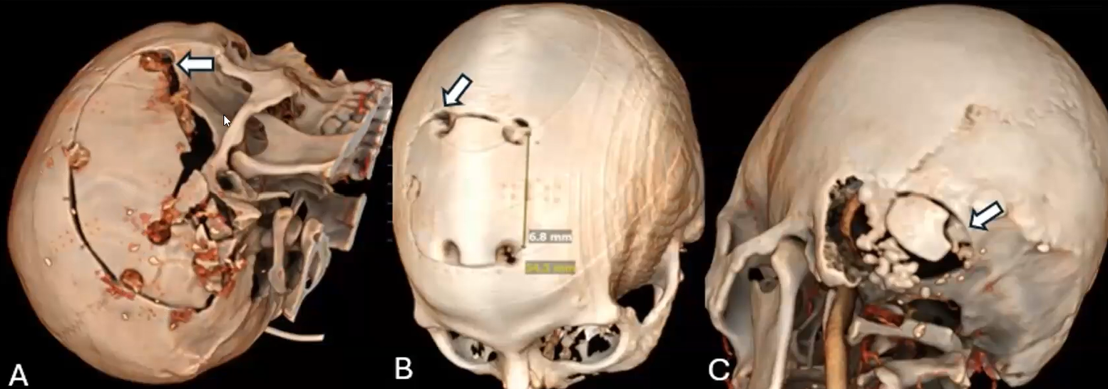 Photos from three angles of a human skull