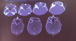 Slide from Dr. McDermott’s lecture on meningioma surgery