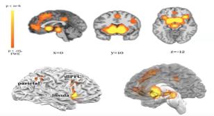 Sub-I Presentations – UW Medicine Neurological Surgery Grand Rounds: 6/18/2025 Brain model