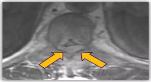 Anubhav G. Amin, MD – UW Medicine Neurological Surgery Grand Rounds: 6/25/2025 CT Scan with arrows