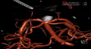 Howard A. Riina, MD, MPhil, FACS, FAANS – UW Medicine Neurological Surgery Grand Rounds: 9/17/2025 Blood vessel diagram